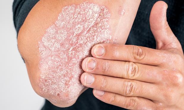 psoriasis