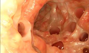Diverticulitis