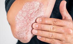 psoriasis