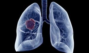 lung cancer